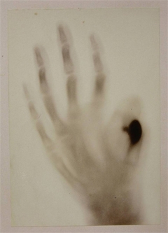 Radiografia mostrando deformaes nos dedos de uma mo, H. Teixeira de Bastos, Fev. 1896, fotografia de A. S. e Sousa